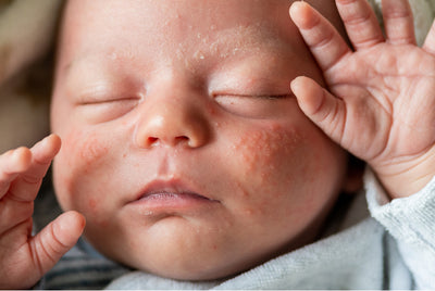 Understanding Baby Eczema